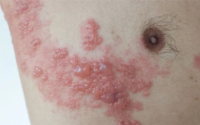 ALMANAQUE-DO-ESTUDANTE-Imagem-Para-o-Artigo-Herpes-Zoster-O-virus-adormecido-que-pode-atacar-decadas-depois-I.webp